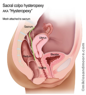 Mesh Attachment to Sacrum – sutures are placed through the anterior ligament of the sacrum and then through the mesh; the mesh attachment to the sacrum reestablishes uterine support 