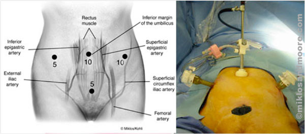 Incision Photo