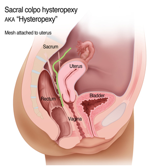 Mesh attached to sacrum - hysteropexy